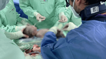 Cirugía a bebé en la placenta de su madre.  Procedimiento EXIT, el primero en Latinoamérica